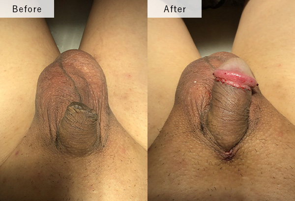 亀頭直下含む美容包茎、亀頭増大(ヒアルロン酸)、ヒーロー式長茎術